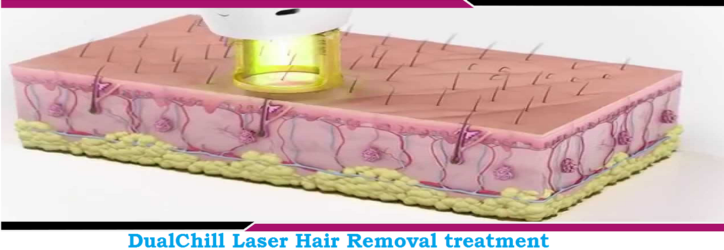 DualChill Laser Hair Removal treatment in chandigarh